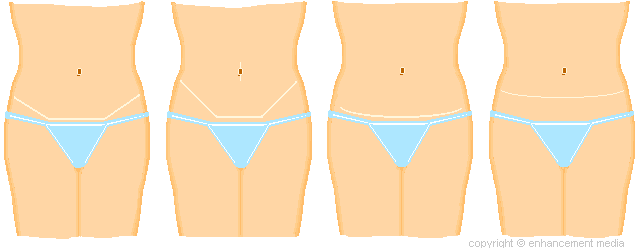 tummy tuck scars. various short-scar and