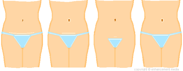 tummy tuck scars. Tummy Tuck Techniques Overview