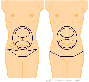 tummy tuck incision markings