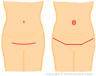 Mini tummy tuck incisions