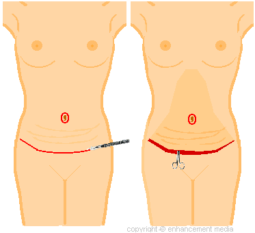 Full abdominoplasty scars