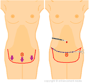 tummy tuck incisions