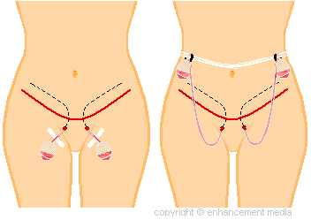 How surgical drains are inserted